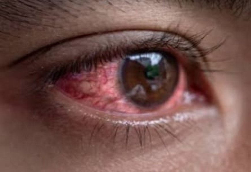 Vigilance necessary for the prevention of eye flu: Dr. Ranjan.